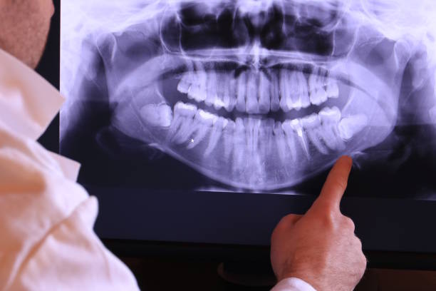 Best Knocked-Out Tooth (Avulsed Tooth) Treatment in Manassas Park, VA