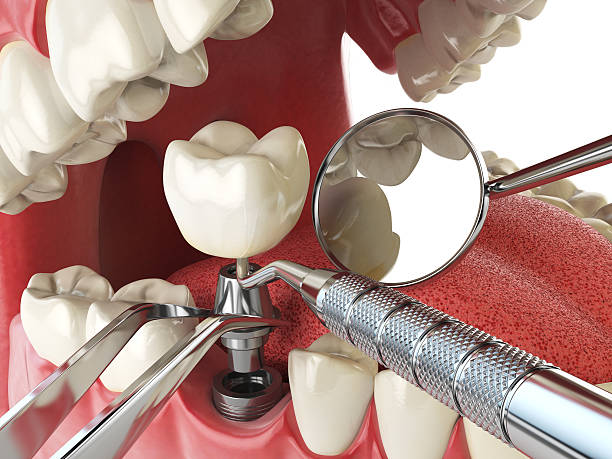 Best Dental Abscess Treatment in Manassas Park, VA